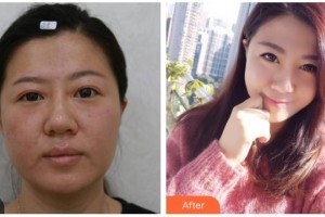 資陽市中醫(yī)醫(yī)院眼科張永整形價(jià)格表附埋線雙眼皮案例展示