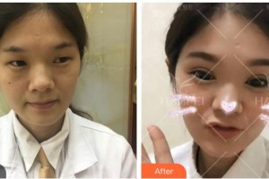 資陽市中醫(yī)醫(yī)院眼科秦慶整形價(jià)格表附切開雙眼皮案例展示