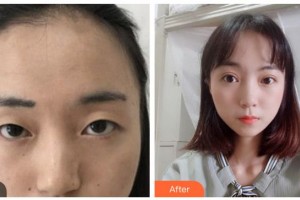 資陽市中醫(yī)醫(yī)院眼科宋良智整形價(jià)格表附切開雙眼皮案例展示