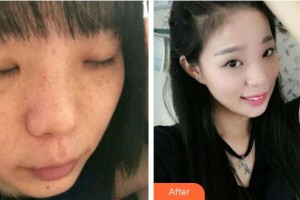 涼山愛麗諾整形美容醫(yī)院聶立敏整形價(jià)格表附清潔祛痘案例展示