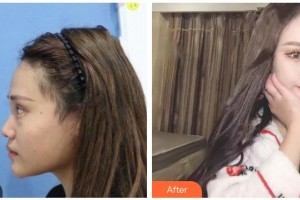 涼山愛麗諾整形美容醫(yī)院涂文浩整形價(jià)格表附鼻部綜合案例展示