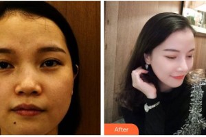 涼山彝族自治州第一人民醫(yī)院燒傷整形科殷秀清整形價(jià)格表附鼻部綜合案例展示