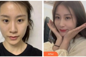 涼山愛爾眼科醫(yī)院肖玲整形價(jià)格表附切開雙眼皮案例展示