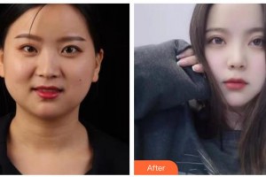 涼山愛(ài)爾眼科醫(yī)院李國(guó)良整形價(jià)格表附眼部綜合案例展示