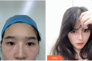 涼山愛(ài)爾眼科醫(yī)院黃應(yīng)祥整形價(jià)格表附眼部修復(fù)案例展示