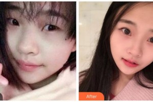 涼山州中西醫(yī)結(jié)合醫(yī)院眼科陳浩整形價(jià)格表附切開(kāi)雙眼皮案例展示