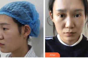 涼山愛(ài)爾眼科醫(yī)院吉江峰整形價(jià)格表附眼部綜合案例展示