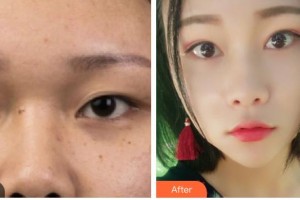 涼山州中西醫(yī)結(jié)合醫(yī)院眼科張薇整形價(jià)格表附切開(kāi)雙眼皮案例展示