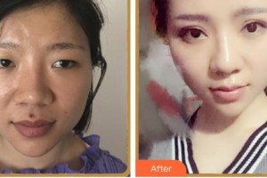 湖南黃興醫(yī)院整形美容中心李教授整形價格表附眼部綜合案例展示