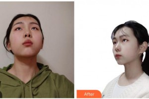 湖南黃興醫(yī)院整形美容中心傅醫(yī)師整形價格表附光子嫩膚案例展示