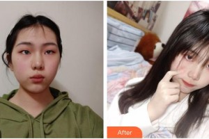 湖南省人民醫(yī)院整形激光美容中心鄒勃生整形價格表附激光祛斑案例展示