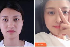 湖南愛薇爾醫(yī)療美容門診部何煒華整形價格表附眼部綜合案例展示