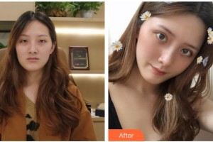 武警湖南總隊醫(yī)院整形美容中心袁華整形價格表附切開雙眼皮案例展示