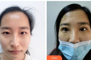 武警湖南總隊醫(yī)院整形美容中心包校偉整形價格表附眼部綜合案例展示