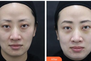 武警湖南總隊醫(yī)院整形美容中心夏紅梅整形價格表附激光去眼袋案例展示