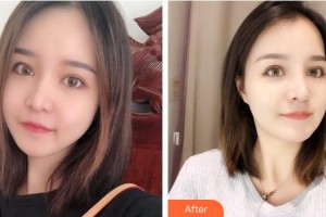 湖南省人民醫(yī)院整形激光美容中心李高峰整形價格表附面部吸脂案例展示