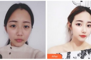 武警湖南總隊醫(yī)院整形美容中心高衛(wèi)先整形價格表附埋線提升案例展示