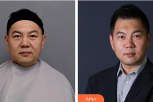 湖南省人民醫(yī)院整形激光美容中心朱軼整形價格表附埋線提升案例展示