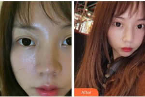 湖南省人民醫(yī)院整形激光美容中心李波整形價格表附熱瑪吉案例展示