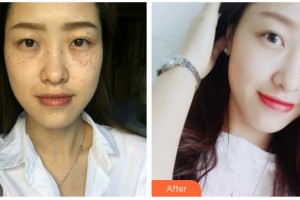 湖南省人民醫(yī)院整形激光美容中心吳東輝整形價格表附鐳射凈膚案例展示