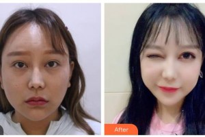 湖南省人民醫(yī)院整形激光美容中心羅滔整形價格表附眼部綜合案例展示