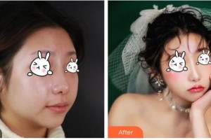 湖南省南華大學(xué)附一醫(yī)院激光美容中心謝紅炬整形價格表附激光祛斑案例展示