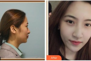 湖南省南華大學(xué)附一醫(yī)院激光美容中心段非交整形價格表附水氧活膚案例展示