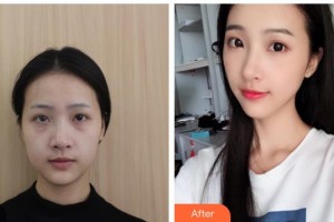 湖南中醫(yī)藥大學(xué)第一附屬醫(yī)院整形美容中心楊文彪整形價格表附埋線提升案例展示