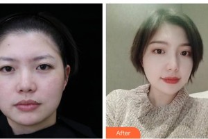 湖南中醫(yī)藥大學(xué)第一附屬醫(yī)院整形美容中心李定文整形價格表附熱瑪吉案例展示