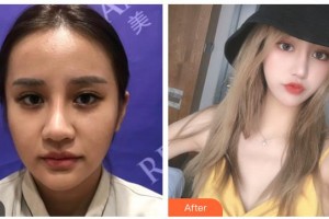 湖南省第二人民醫(yī)院整形美容中心朱飛玲整形價格表附熱瑪吉案例展示