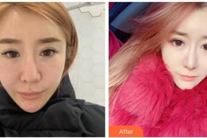 湖南師范大學第二附屬醫(yī)院燒傷整形美容中心李季整形價格表附熱瑪吉案例展示