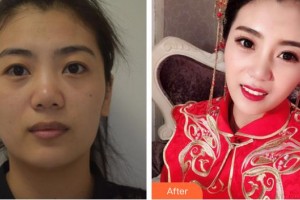 湖南師范大學第二附屬醫(yī)院燒傷整形美容中心潘飛 整形價格表附埋線提升案例展示