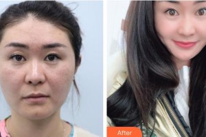 武警湖南總隊醫(yī)院整形美容中心吳忠好整形價格表附埋線提升案例展示