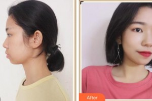 湖南省第二人民醫(yī)院整形美容中心呂霞整形價格表附清潔祛痘案例展示