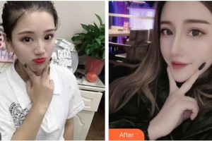 湖南美研醫(yī)療美容門診部張彬整形價格表附鼻部綜合案例展示