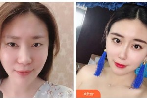 湖南美研醫(yī)療美容門診部冷美林整形價格表附鼻部綜合案例展示