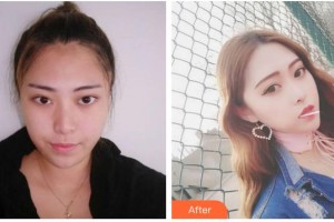 湖南愛薇爾醫(yī)療美容門診部周瑞春整形價格表附鼻部綜合案例展示