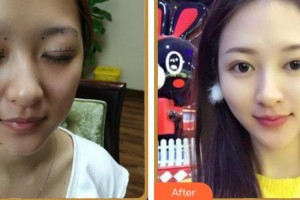 湖南博雅眼科醫(yī)院羅知衛(wèi)整形價格表附眼部綜合案例展示