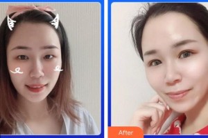 湖南博雅眼科醫(yī)院姜德詠整形價格表附眼部綜合案例展示