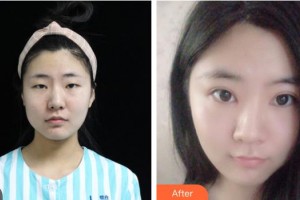 湖南博雅眼科醫(yī)院袁苑整形價格表附切開雙眼皮案例展示