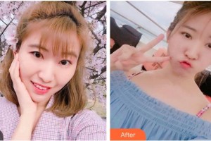 湖南博雅眼科醫(yī)院袁東坡整形價格表附切開雙眼皮案例展示