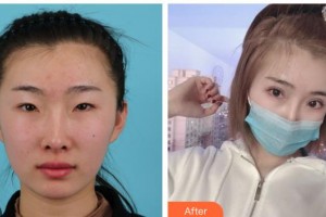 湖南博雅眼科醫(yī)院劉三元整形價格表附眼部綜合案例展示