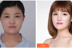 湖南博雅眼科醫(yī)院余輝整形價格表附眼部綜合案例展示