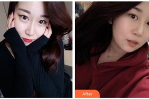 湖南博雅眼科醫(yī)院劉素平整形價格表附切開雙眼皮案例展示