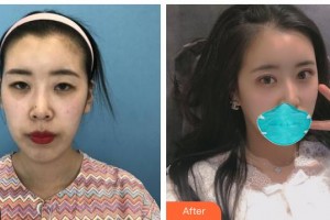 湖南博雅眼科醫(yī)院林影芳整形價格表附眼部綜合案例展示