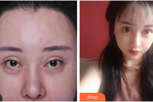 湖南省直中醫(yī)醫(yī)院眼科李用真整形價格表附眼部修復案例展示