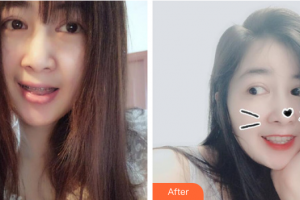 深圳口腔診所王杰整形價格表附自鎖矯正案例展示