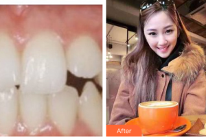 深圳口腔診所曾翠英整形價格表附牙齒矯正案例展示