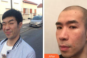 深圳美加美醫(yī)療美容門診部張顯平整形價格表附切開雙眼皮案例展示