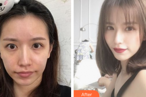 深圳美加美醫(yī)療美容門診部李月慶整形價格表附埋線提升案例展示